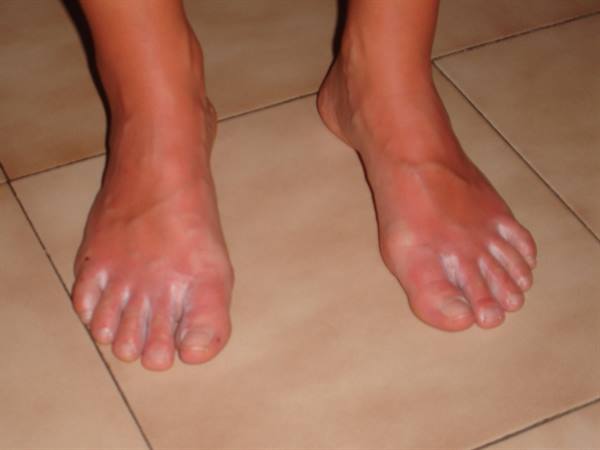 burnt feet